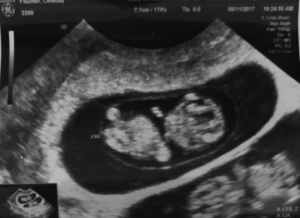 twin ultrasound